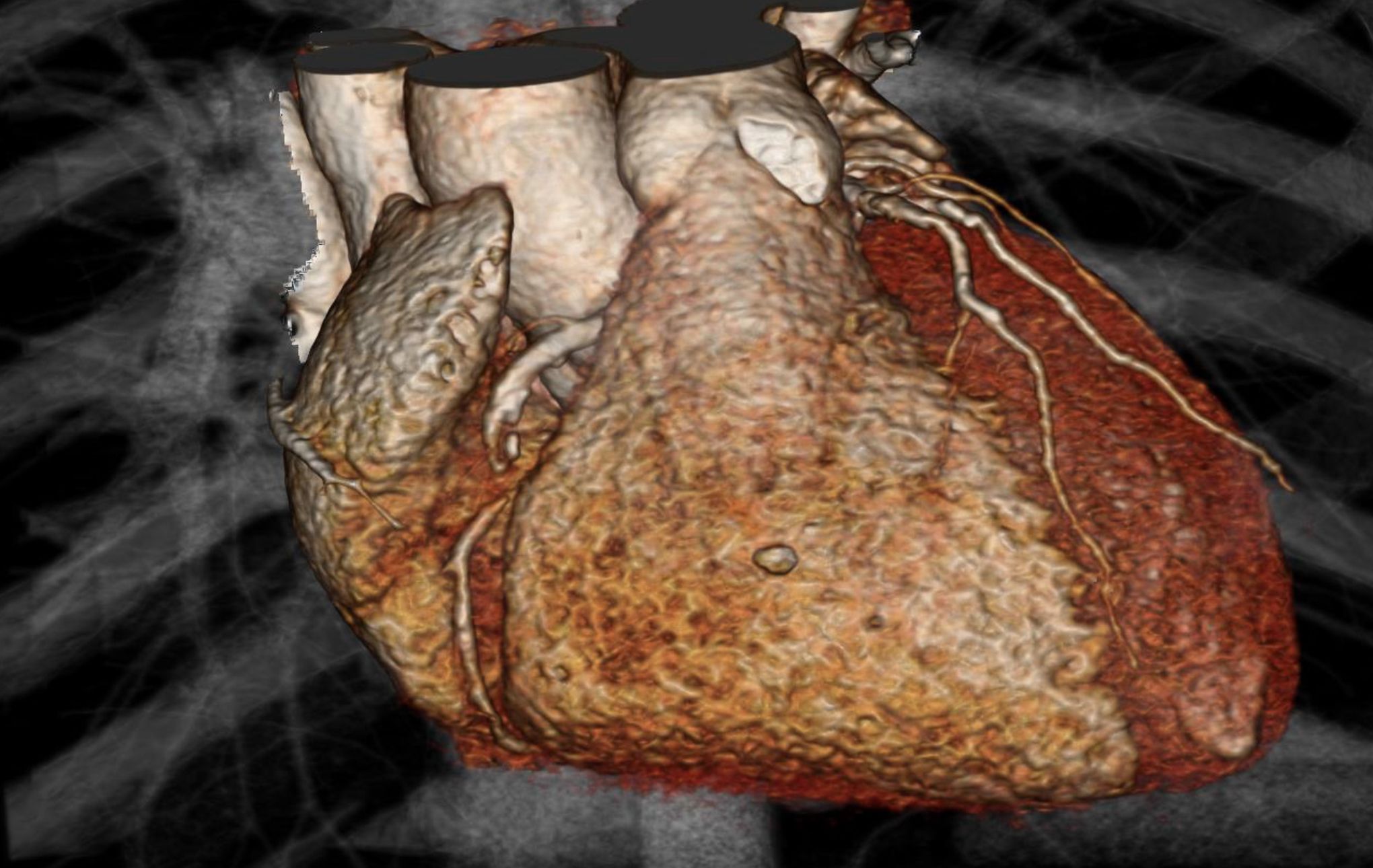 What Does Ct Scan Of Heart Detect