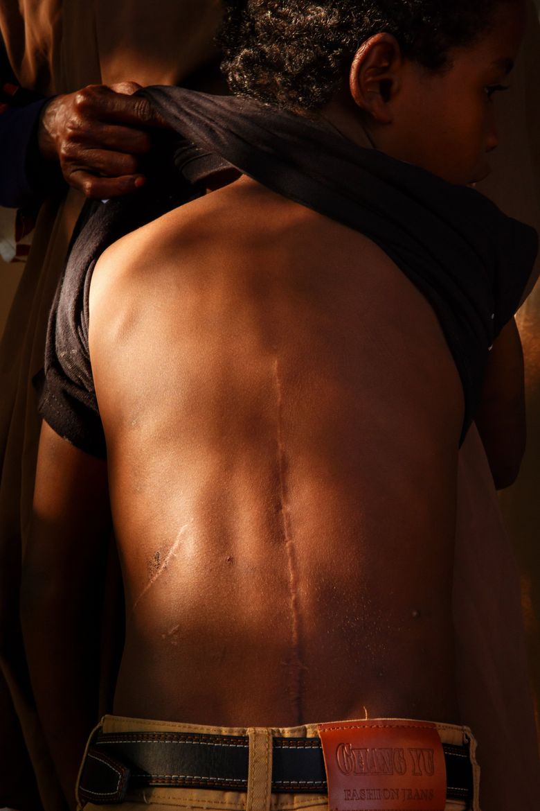 Hassan shows her son Ibrahim’s spinal surgery scars. Because of her son’s health issues, Hassan fears leaving him alone, even to attend ESL classes and to look for work. (Erika Schultz/The Seattle Times)