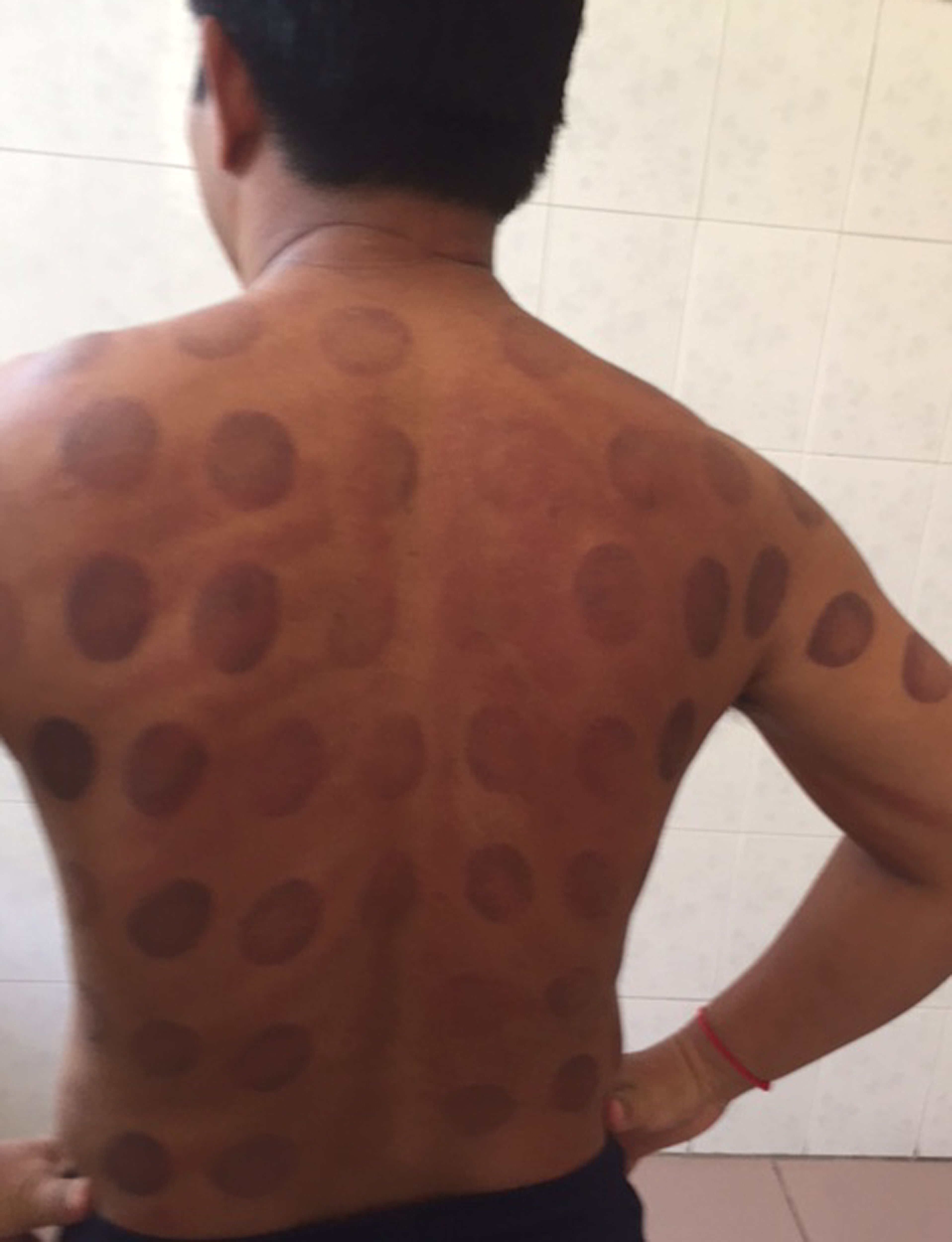 Cupping and coining I did it long before Phelps The Seattle Times