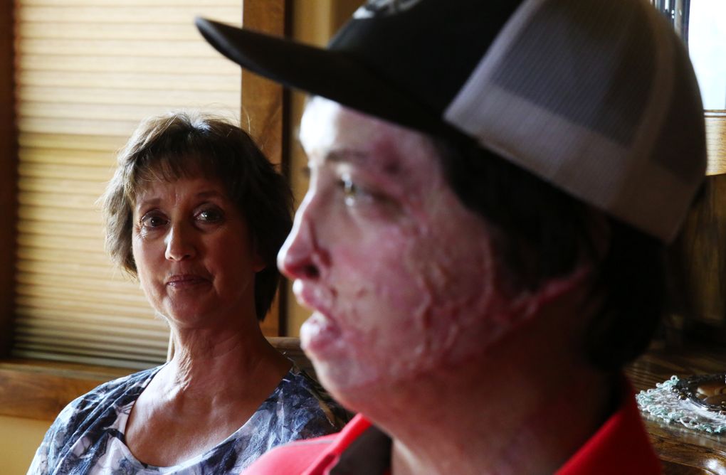 After 11 skin grafts, Daniel Lyon Jr. still faces a decade of additional surgeries. “You got to take it just a little bit at a time,” he says. “It’s just a daunting task.” Barbara Lyon says her son has come a long way emotionally from his early days home from the hospital. (Ken Lambert/The Seattle Times)