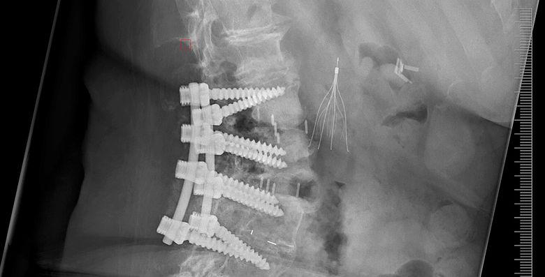 This X-ray from October 2014 shows the hardware in Orna Berkowitz’s lower spine from two operations that year. She didn’t know that, during those entire surgeries, her doctor also had cases in other operating rooms. (Courtesy of Orna Berkowitz)