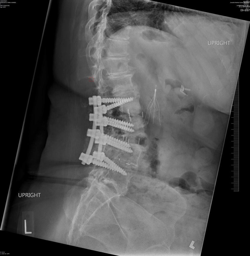 This X-ray from October 2014 shows the hardware in Orna Berkowitz’s lower spine from two operations that year. She didn’t know that, during those entire surgeries, her doctor also had cases in other operating rooms. In the days that followed, Berkowitz developed a series of problems that forced her to undergo three more surgeries. (Courtesy of Orna Berkowitz)
