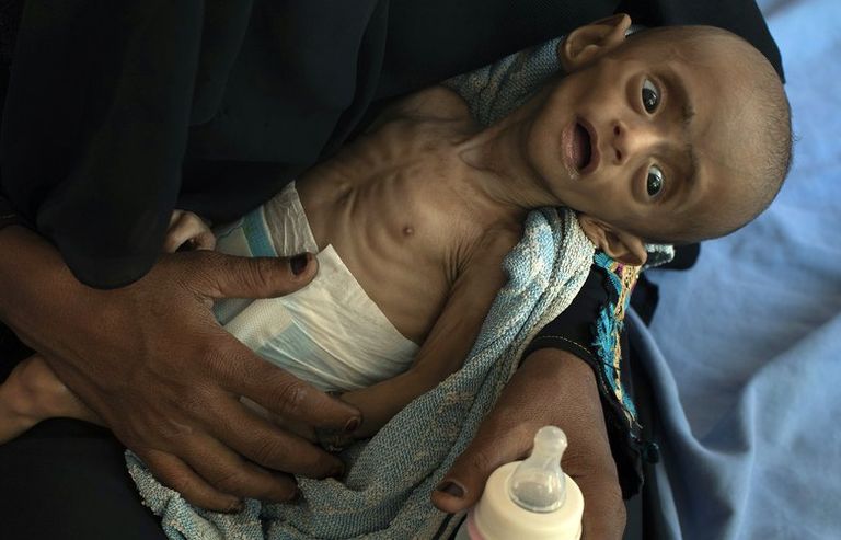 Yemeni Girl Who Turned World’s Eyes To Famine Has Died 