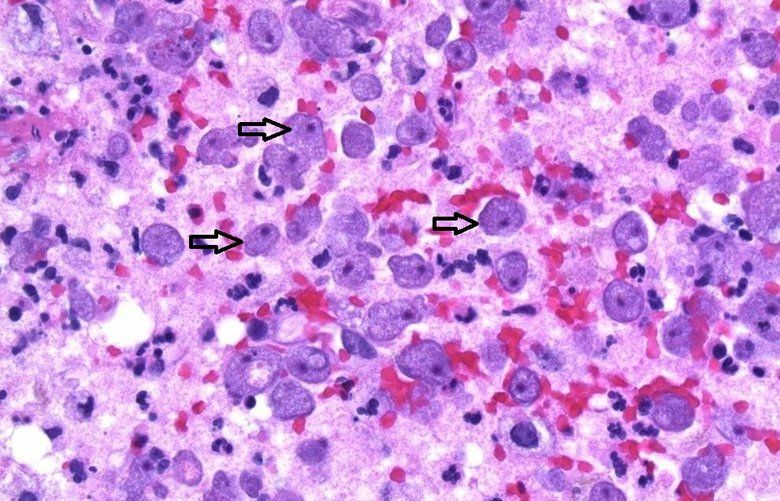 Photographed under a microscope, arrows point to the amoebas, balamuthia mandrillaris, found in the Seattle woman?s brain. Fatal in around 89 percent of cases, the amoeba can cause death in weeks to months of initial infection. (Photo by Sean Thornton, a pathologist at Swedish Medical Center)
