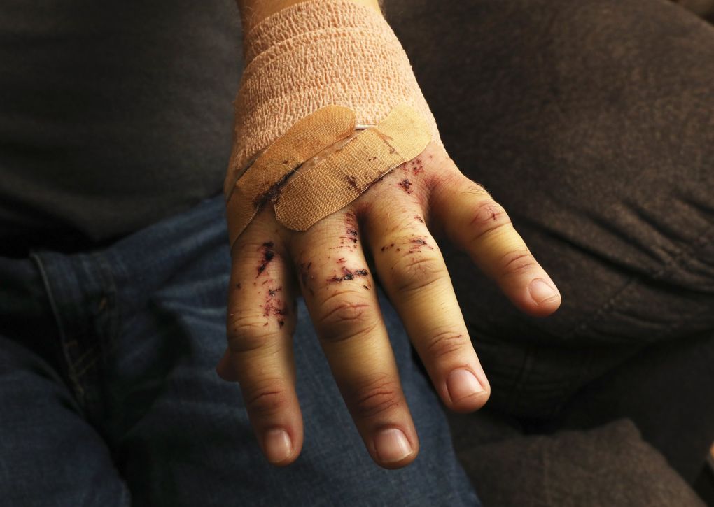 Tom Cook’s hand, which was on the steering wheel when a utility pole smashed his windshield onto it like a hammer. (Ken Lambert / The Seattle Times)