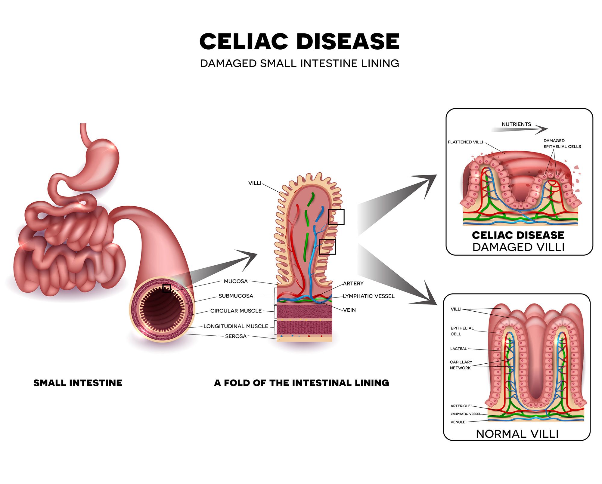 New study calls for screening of family members of celiac-disease