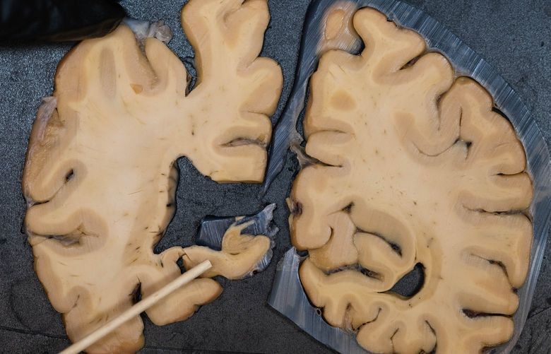This is a cross-section of the brain of former Washington Football Coach Jim Lambright.
After his death, former Washington Football coach Jim Lambright’s brain was donated to the UW Medicine Brain Repository.
Photographed Friday, May 13, 2022 220351