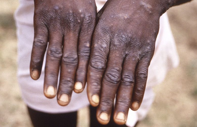 This 1997 image provided by the CDC  during an investigation into an outbreak of monkeypox, which took place in the Democratic Republic of the Congo (DRC), formerly Zaire, and depicts the dorsal surfaces of the hands of a monkeypox case patient, who was displaying the appearance of the characteristic rash during its recuperative stage. As more cases of monkeypox are detected in Europe and North America in 2022, some scientists who have monitored numerous outbreaks in Africa say they are baffled by the unusual disease’s spread in developed countries.  (CDC via AP) NY109 NY109