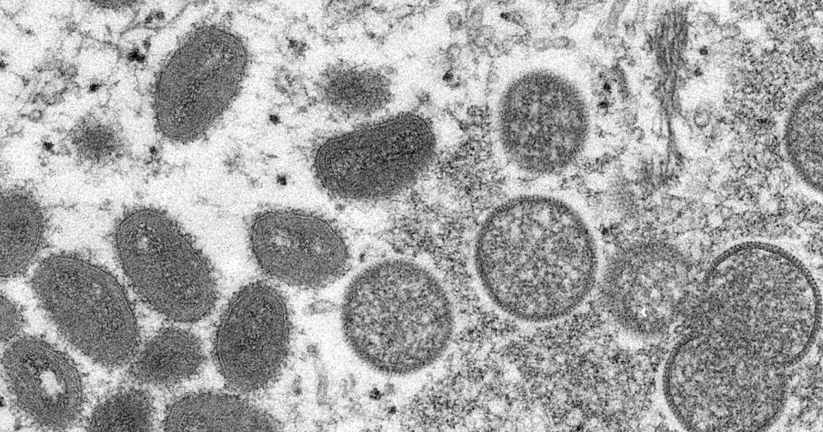 Watch Monkeypox in the COVID era: Here are the key differences between the viruses – Latest News