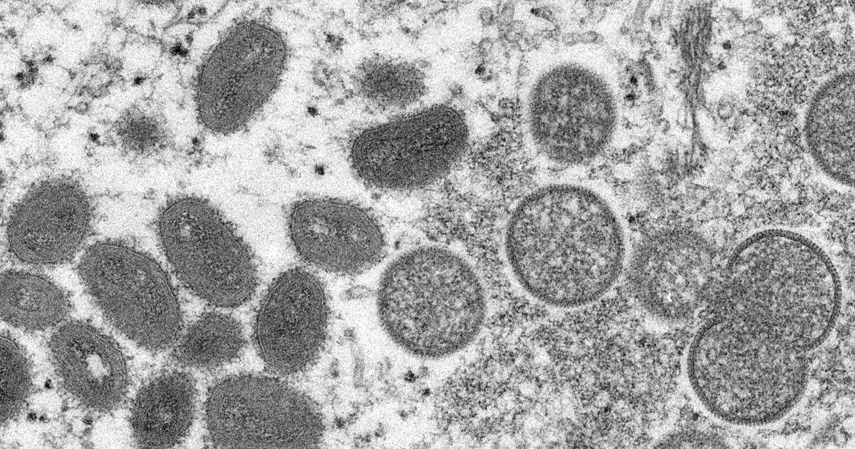 Israël signale le premier cas de monkeypox, d’autres suspects