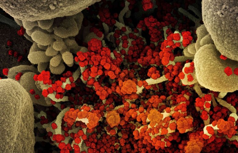 Colorized scanning electron micrograph of a cell heavily infected with COVID-19 virus particles (orange/red), isolated from a patient sample. The image was captured at the NIAID Integrated Research Facility (IRF). (NIAID via ZUMA Wire/TNS) 49606905W 49606905W