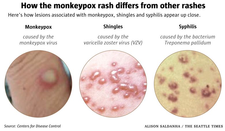 What to Know about the Monkeypox Outbreak in Seattle