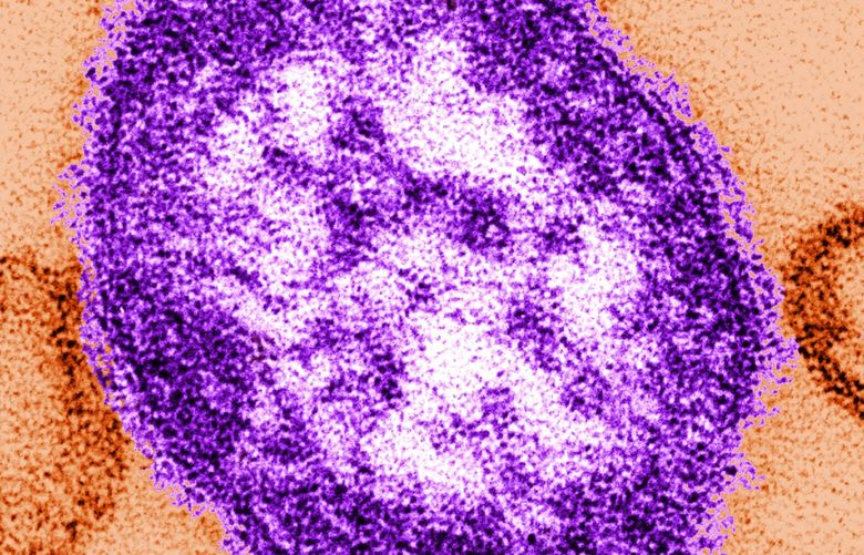 This undated image made available by the Centers for Disease Control and Prevention on Feb. 4, 2015 shows an electron microscope image of a measles virus particle, center. Measles is considered one of the most infectious diseases known. The virus is spread through the air when someone infected coughs or sneezes. (AP Photo/Centers for Disease Control and Prevention, Cynthia Goldsmith) NYPS350