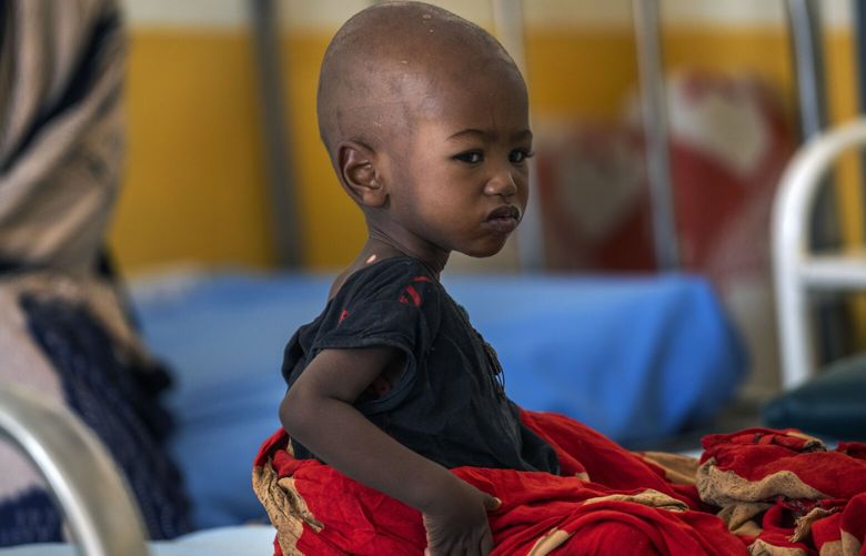 A malnourished child sits at a clinic in Dollow, Somalia, on Wednesday, Sept. 21, 2022. Within weeks, a famine could be declared in Somalia, affecting hundreds of thousands of people. Such a declaration is rare and a sign of the dire consequences from the worst drought in decades in the Horn of Africa. (AP Photo/Jerome Delay) CLI801 CLI801