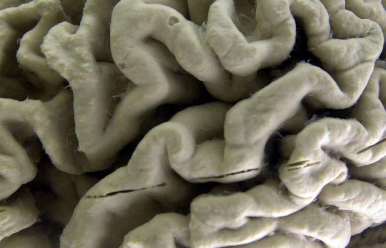 FILE – This Oct. 7, 2003 file photo shows a closeup of a human brain affected by Alzheimer’s disease, on display at the Museum of Neuroanatomy at the University at Buffalo in Buffalo, N.Y. An experimental Alzheimer’s drug modestly slowed the brain disease’s inevitable worsening, researchers reported Tuesday, Nov. 29, 2022 – and the next question is how much difference that might make in people’s lives. Japanese drugmaker Eisai and its U.S. partner Biogen had announced earlier this fall that the drug lecanemab appeared to work, a badly needed bright spot after repeated disappointments in the quest for better Alzheimer’s treatments. (AP Photo/David Duprey) NY885 NY885