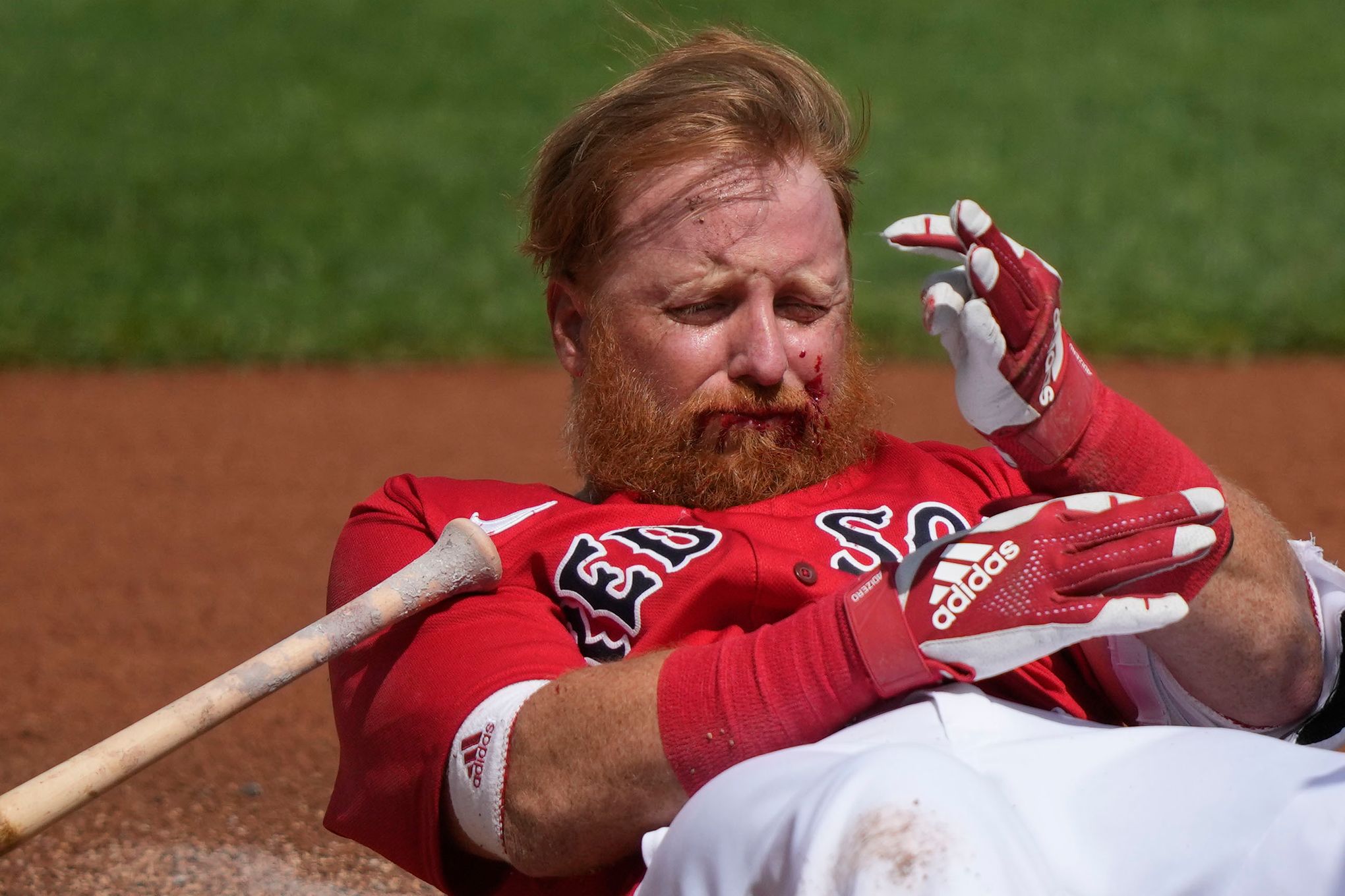 Justin Turner injury: Red Sox 1B/DH exits game after being hit in