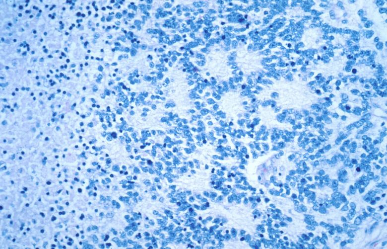 This December 1993 microscope photo provided by the National Cancer Institute shows a typical neuroblastoma with rosette formation. In a study published Wednesday, April 5, 2023, in the New England Journal of Medicine, a novel treatment, CAR-T cell therapy, using supercharged immune cells, appears to work against tumors in children with the rare kind of cancer. (Dr. Maria Tsokos/National Cancer Institute via AP) NY382 NY382