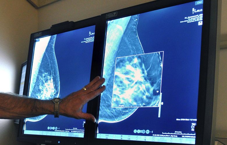 FILE – In this Tuesday, July 31, 2012, file photo, a radiologist compares an image from earlier, 2-D technology mammogram to the new 3-D Digital Breast Tomosynthesis mammography in Wichita Falls, Texas. The technology can detect much smaller cancers earlier. In guidelines published Tuesday, Oct. 20, 2015, the American Cancer Society revised its advice on who should get mammograms and when, recommending annual screenings for women at age 45 instead of 40 and switching to every other year at age 55. The advice is for women at average risk for breast cancer. Doctors generally recommend more intensive screening for higher-risk women. (Torin Halsey/Times Record News via AP)