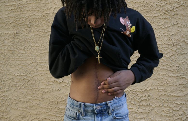 Caison Robinson, 14, who suffered wounds from five gunshots that were fired in a matter of moments, shows  a scar from his surgery, in Las Vegas, July 29, 2023. Police say that Robinson, who was outside his home while playing with a 12-year-old neighbor, was shot by a pistol modified with device called a switch, which can transform semiautomatic handguns into fully automatic machine guns that fire dozens of bullets with one tug on the trigger. (Bridget Bennett/The New York Times)