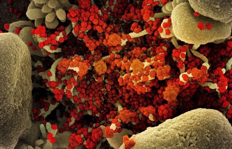 Colorized scanning electron micrograph of a cell heavily infected with SARS-CoV-2 virus particles (orange/red), isolated from a patient sample. The image was captured at the NIAID Integrated Research Facility. (NIAID via ZUMA Wire/TNS) 100713414W