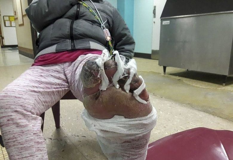 Woman has five toes amputated after catching an infection from a