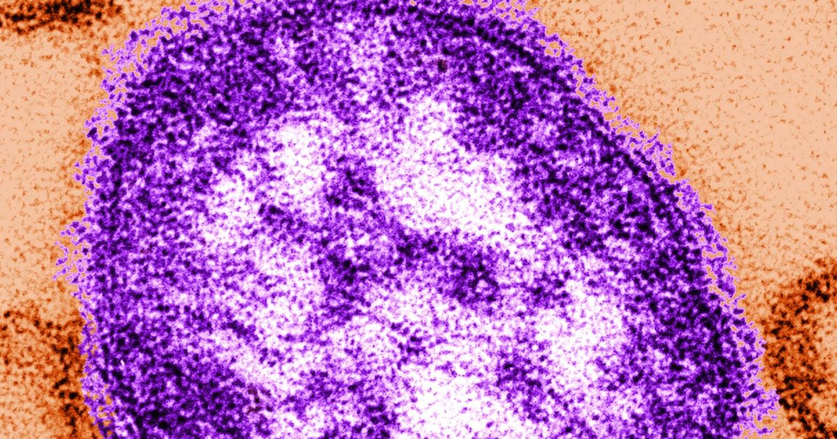 First measles case confirmed this year in King County resident