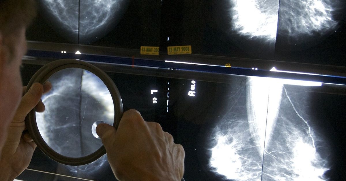 No family history? Under 40? Why common breast cancer myths put you at risk