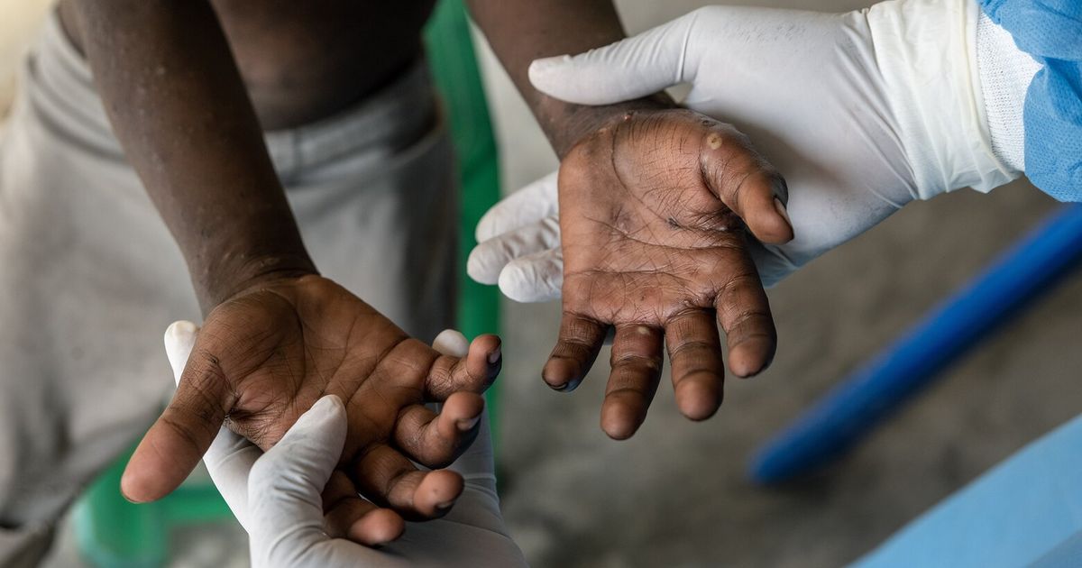 Sin vacunas, tests ni tratamientos: el Congo carece de herramientas para afrontar el mpox