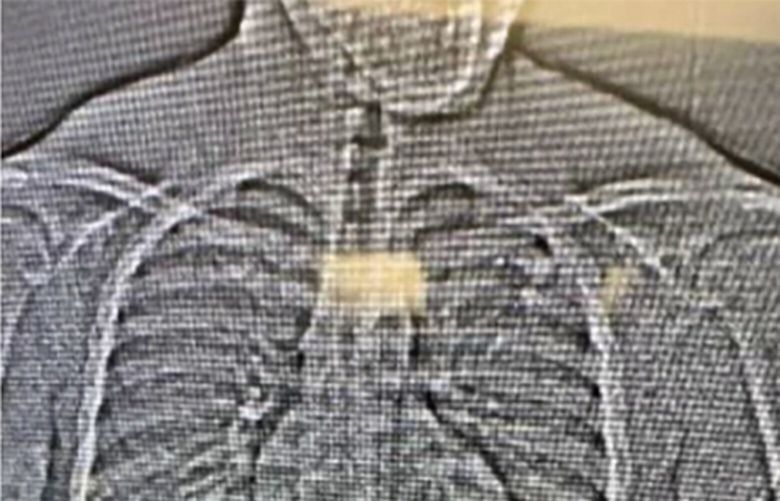 This image provided by the Orlando District Attorney’s office shows an x-ray showing earrings and a ring that were stolen from a Tiffany & Co. jewelry store in central Florida and were swallowed by the suspect.  ( Orlando District Attorney’s office via AP) FLPD101 FLPD101