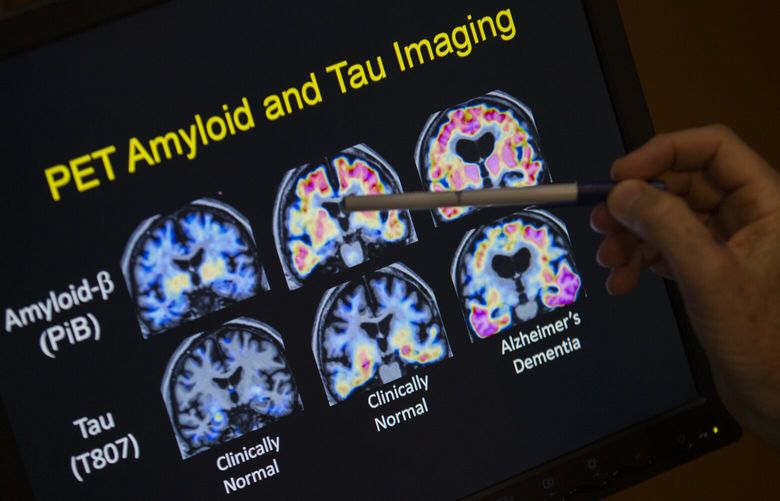 FILE – R. Scott Turner, Professor of Neurology and Director of the Memory Disorder Center at Georgetown University Hospital, points to PET scan results that are part of a study on Alzheimer’s disease at Georgetown University Hospital in Washington, May 19, 2015. (AP Photo/Evan Vucci, File) NYRL502 NYRL502