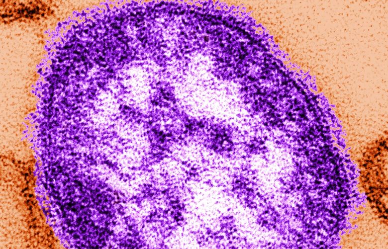 This undated image made available by the Centers for Disease Control and Prevention on Feb. 4, 2015 shows an electron microscope image of a measles virus particle, center. Measles is considered one of the most infectious diseases known. The virus is spread through the air when someone infected coughs or sneezes. (AP Photo/Centers for Disease Control and Prevention, Cynthia Goldsmith) NYPS350