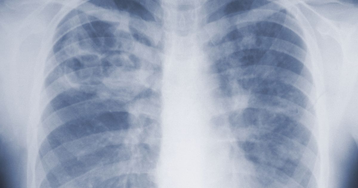 Study suggests the threat of mold-associated illnesses may be underappreciated