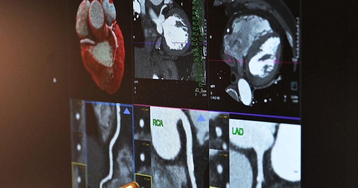 Mayo Clinic Q&A: Heartburn or heart attack? How to tell the difference