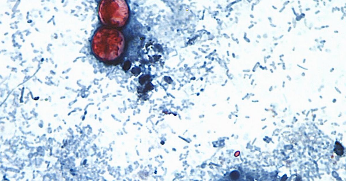 US officials tie cyclospora outbreak involving iceberg lettuce to 3 more states