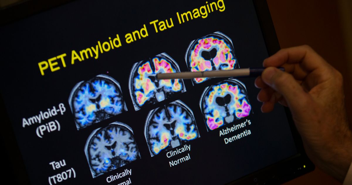 Want to lower your risk of dementia? It doesn’t involve a blood test