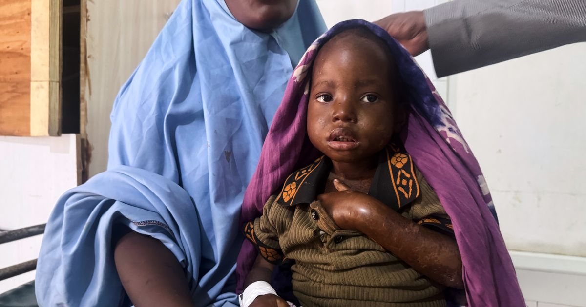 Mother’s 3-day walk with sick daughter highlights Somalia’s child malnutrition emergency